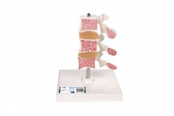 Model ludzkiej osteoporozy (3 kręgi z dyskami), zdejmowany na stojaku - 3B Smart Anatomy - 1000153 [A78]